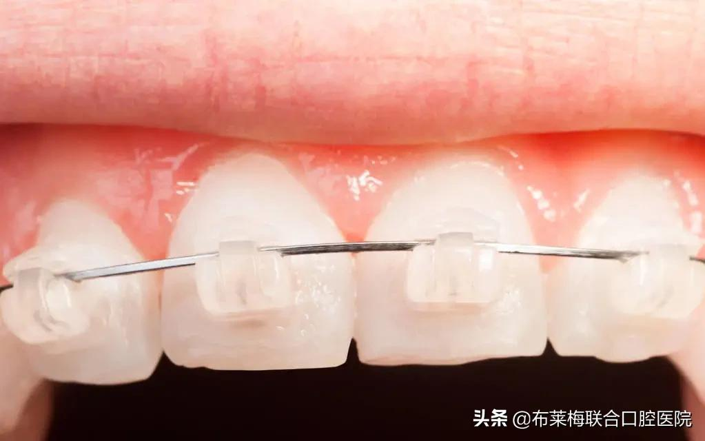 牙齿矫正,你所关心的那些问题