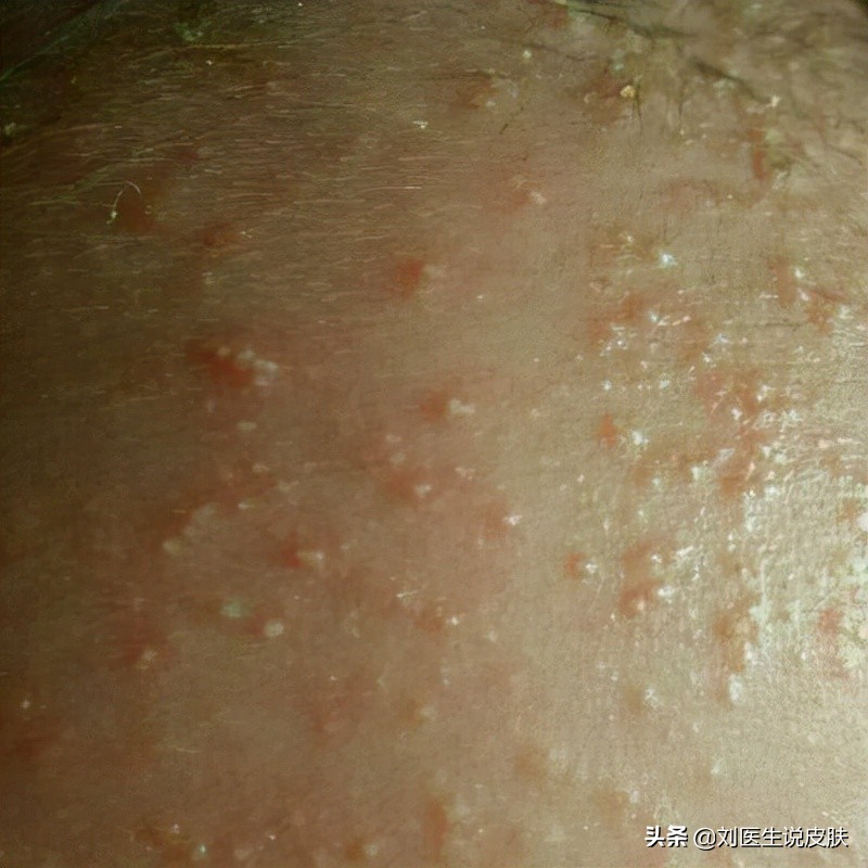 皮肤病涂的含激素软膏，安全吗？你至少要知道这2点