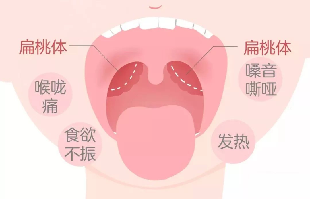 别拿扁桃体发炎不当回事？扁桃体发炎、上火了怎么治