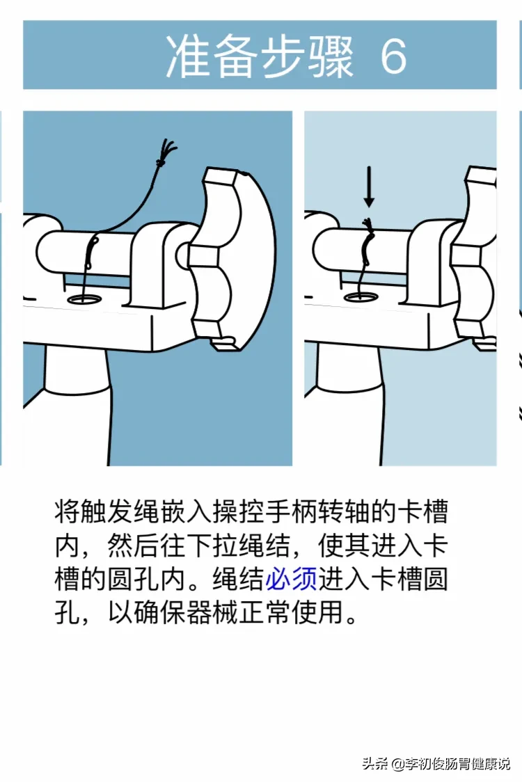 一次肠镜操作，一举三得同时完成肠道检查、套扎止血、消除内痔！