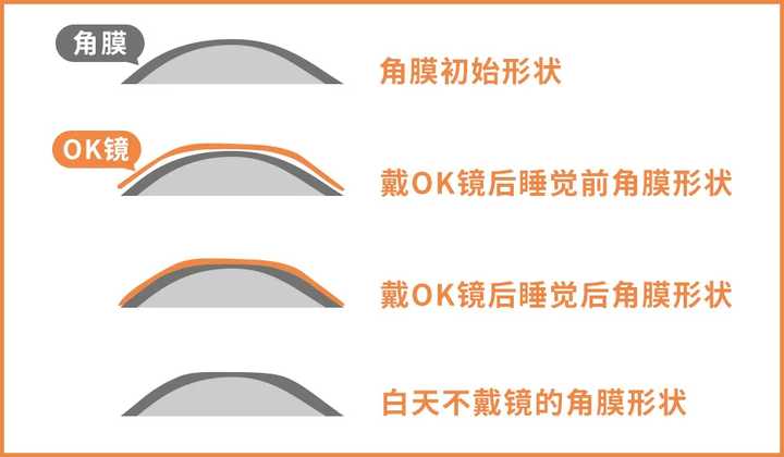 叶黄素？护眼贴？ok镜？近视真的可以治好吗？
