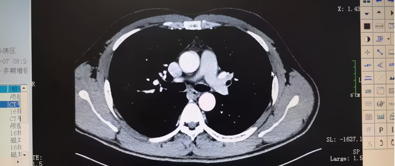 肺癌一查就是晚期？其实身体曾给你5次“暗示”，只是被你忽略了