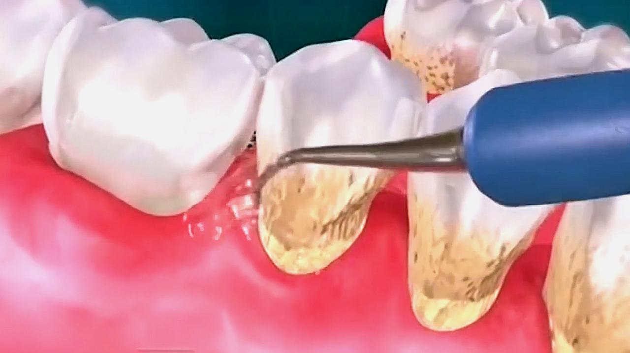 每年洗一次牙到底有没有必要？医生一文为您说清楚