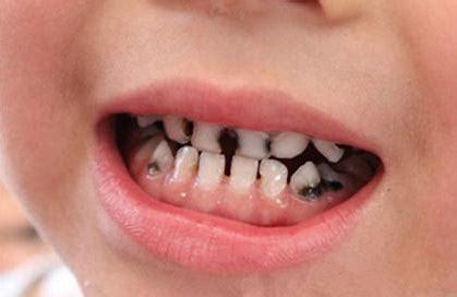 儿童龋齿如何治疗?做好防龋措施