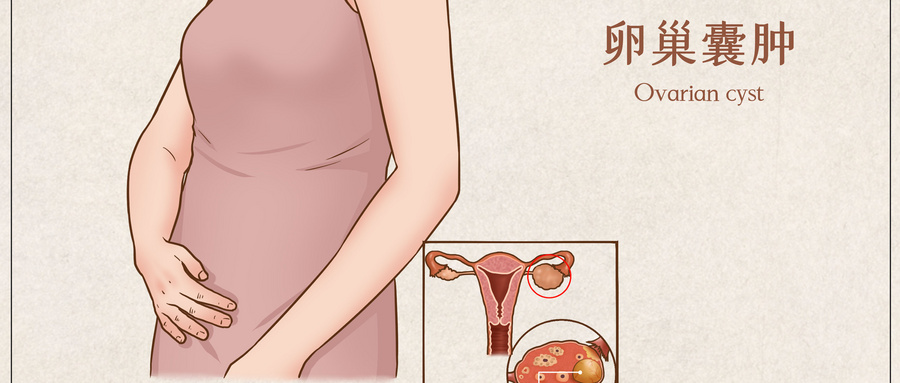 卵巢囊肿要不要手术？主要看你是什么类型的肿瘤，常见的有这些