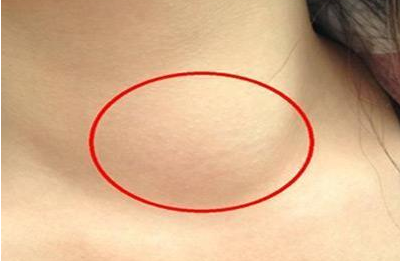 脖子淋巴癌早期图片图片