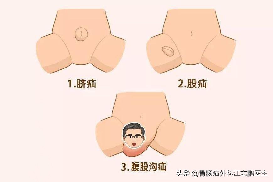 脐疝的治疗——婴幼儿脐疝篇