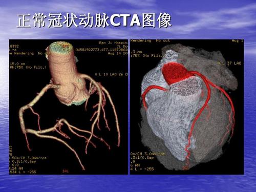 冠心病检查不只有造影！更便宜、有效的检查门诊就能做！值得收藏