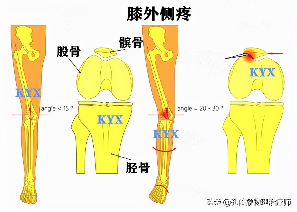 膝蓋一彎就疼怎麼回事(膝關節為什麼疼痛)