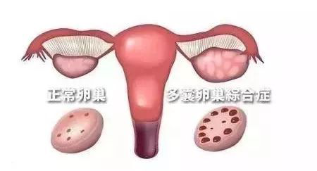 其实食疗才是调理多囊卵巢的一剂猛药，4个小食谱奉上