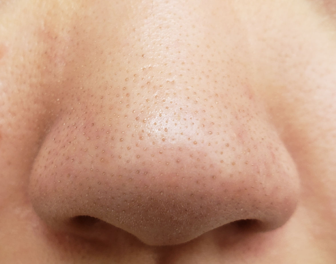 用什么方法去除鼻子上的黑头最有效?