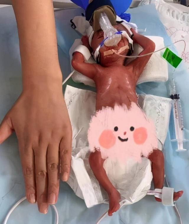 胎儿早产多少周能存活(24周超早产儿出院) - 青木春