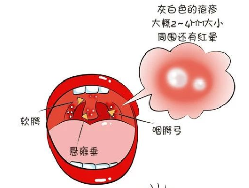 疱疹性咽峡炎高发季节，6岁儿子中招了，照护经验给你，早预防