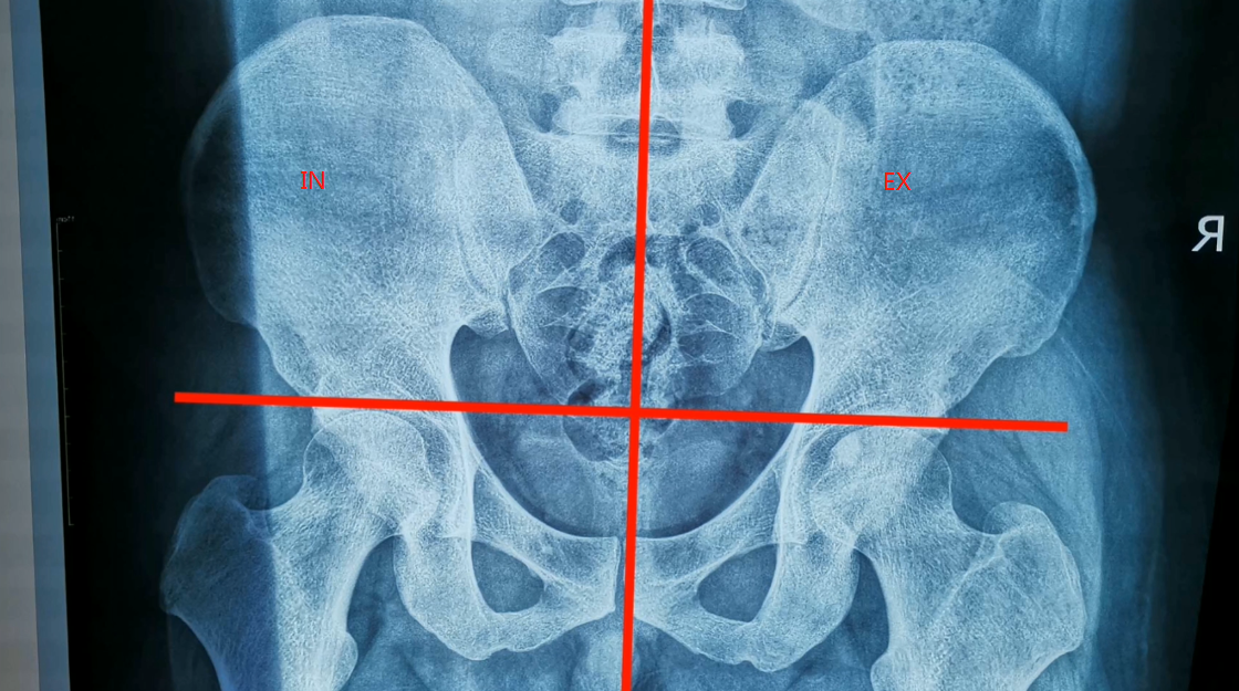 骨盆矫正之如何在x光找到骶骨的错位骶骨错位矫正
