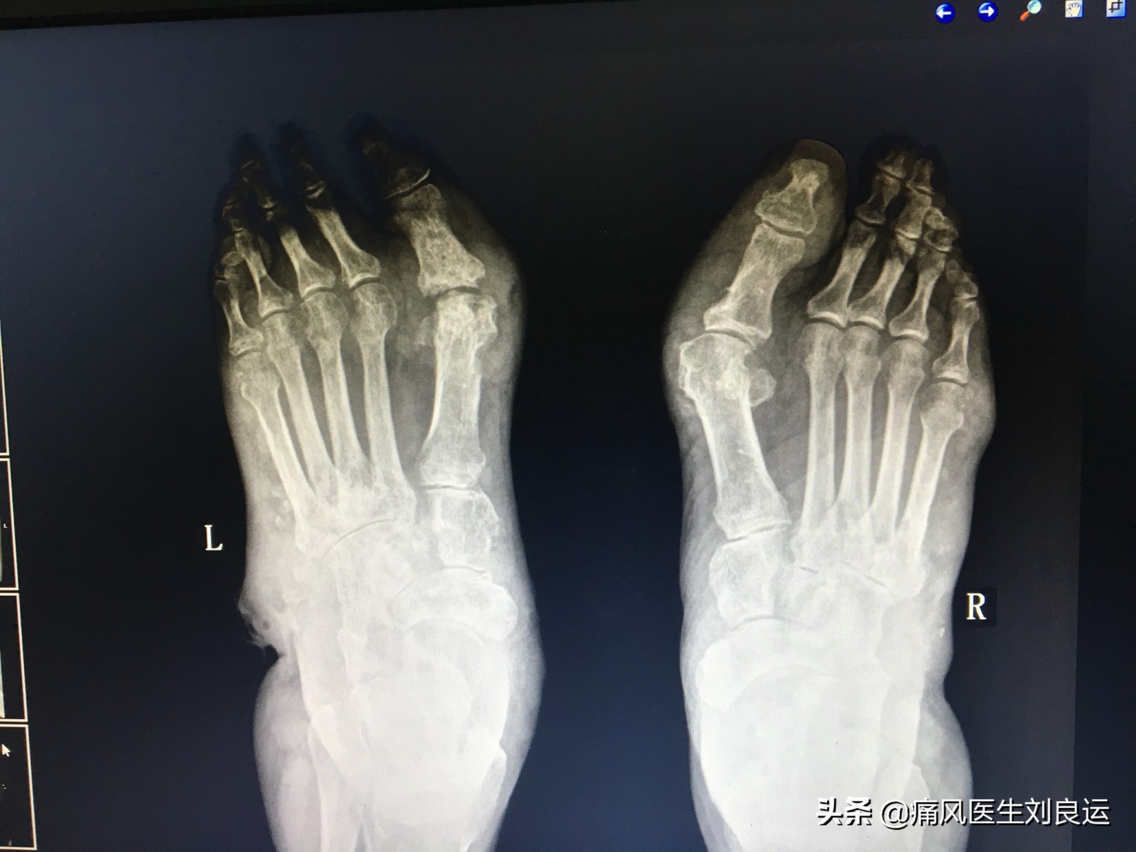 痛风石可以做手术取石吗？如何清除关节处尿酸盐结晶和积液？