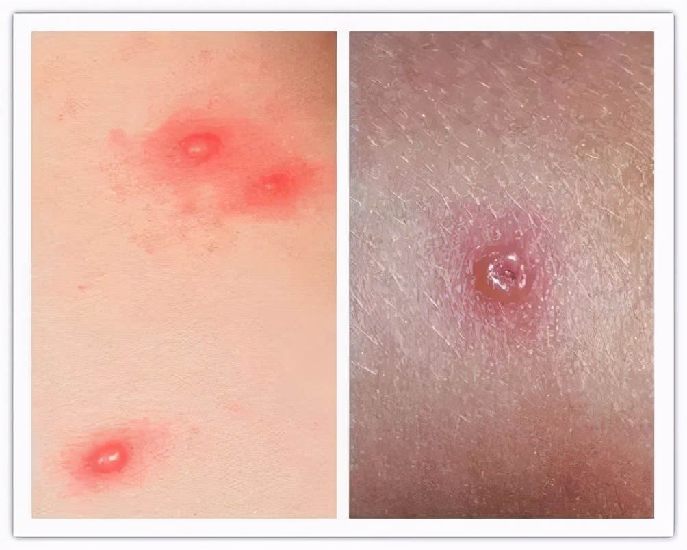 水痘的主要症状图片