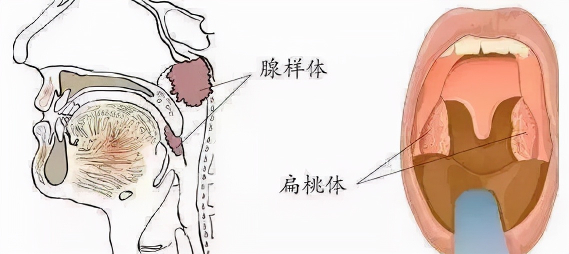 小儿腺样体肥大危害大，中医治疗有优势