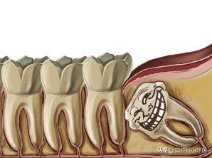 好好的智齿为什么拔了？并且价格比拔其它牙齿贵，听听医生解释！