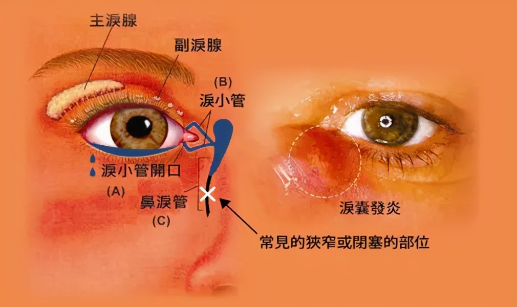 眼角-流白脓、流眼泪，擦了又有，怎么办？