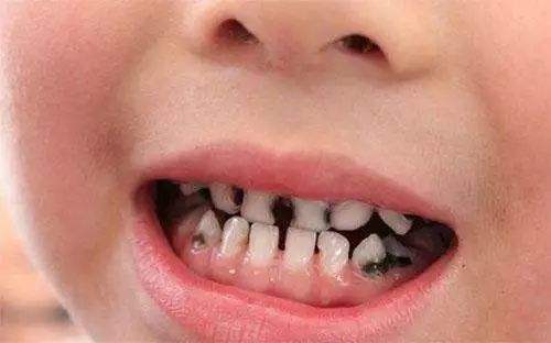 牙根发黑发黄的原因及处理方法