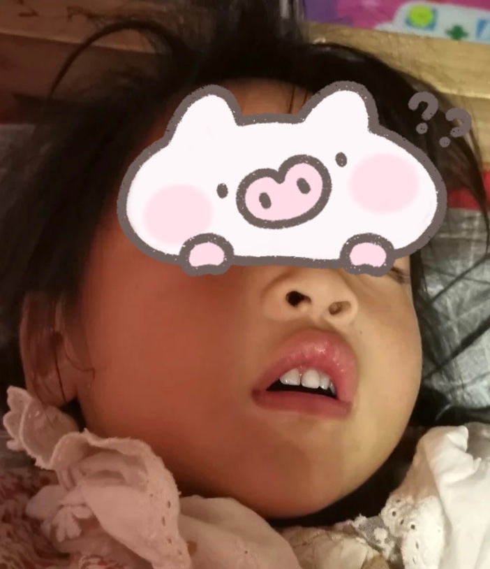 孩子扁桃体反复发炎致细菌感染高烧不退怎么办