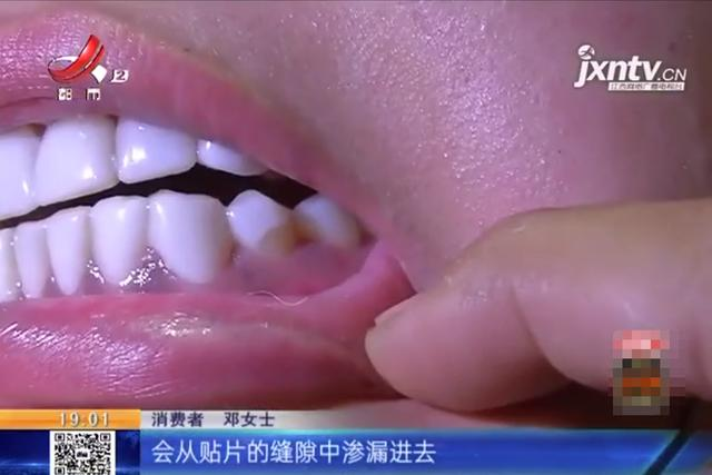 南昌一女子做牙齿贴片，做完后悔不已：“牙齿无法闭合了！”
