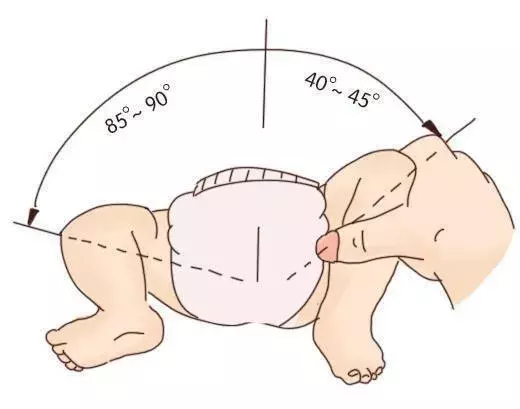 宝宝臀纹不对称妈妈不上心,长大后孩子走路一瘸一拐