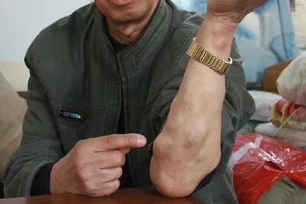 为什么身上总长脂肪瘤?医生提醒:3个诱因,要及时避免