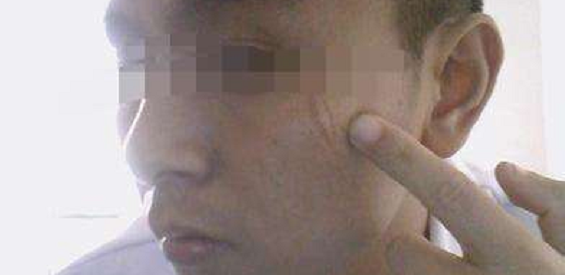 3岁男童被鸡抓伤，竟“长出”鸡趾甲？怕留疤痕，家长好心办坏事