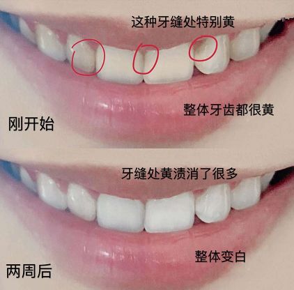 你知道“小巨蛋”吗？10s抗糖美白牙齿，效果比洗牙好太多了