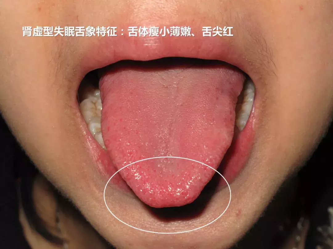人到中年一觉难求,常常失眠惊醒早醒,中成药按摩并用治疗效果好
