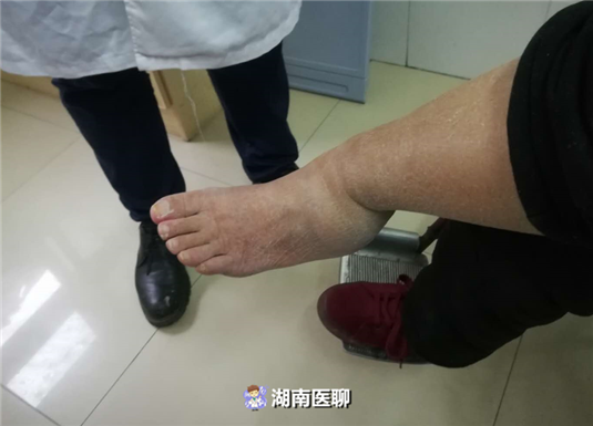 疼!长沙67岁老人初雪日摔骨折