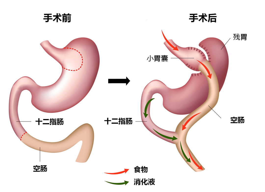 切掉大半个胃，只为了治疗糖尿病？减重手术治疗糖尿病可靠吗？
