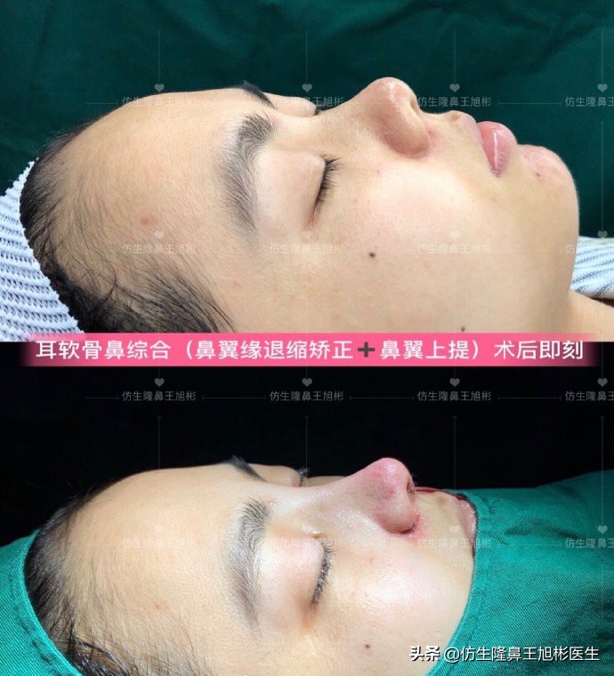 单纯隆鼻是什么，和综合隆鼻有什么区别？