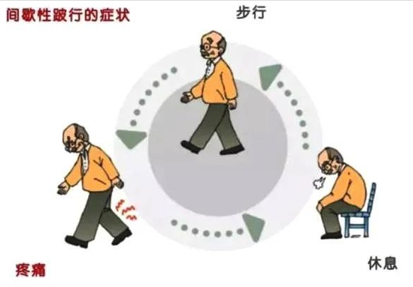 动脉血管堵塞如何治疗？老人血管堵塞的治疗方法与注意事项