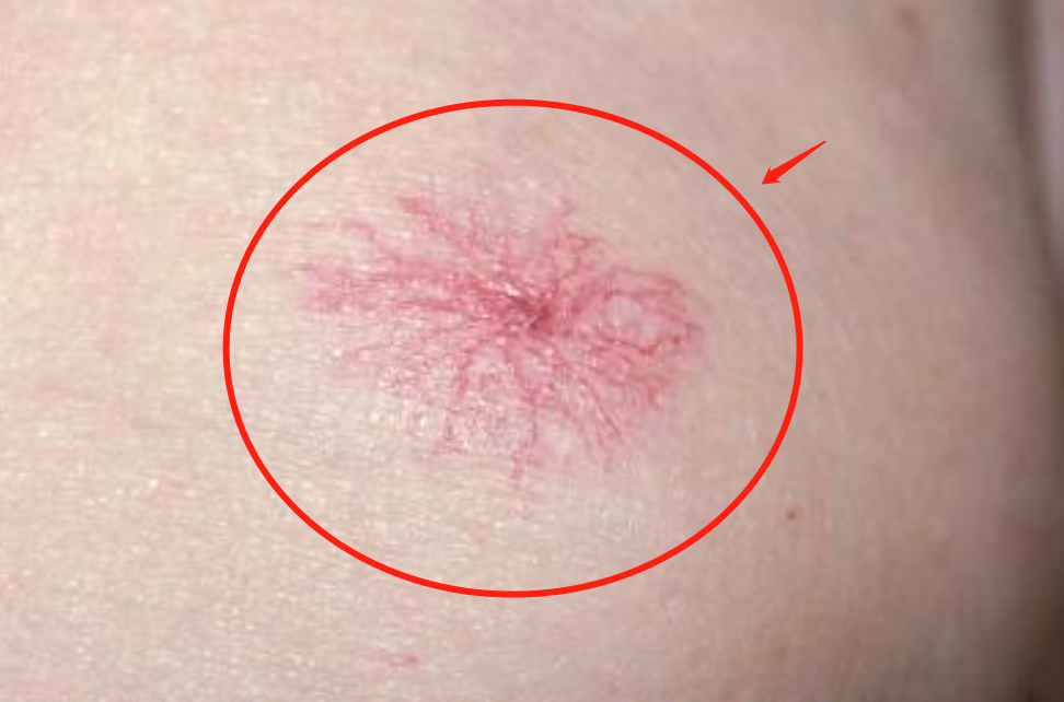 身上出现"红痣",这是肝病在"作祟"?或与这2个原因有关