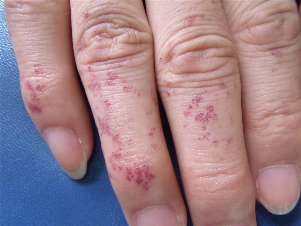 阴囊型又称fordyce血管角化瘤.这里我们主要介绍阴囊型.阴囊