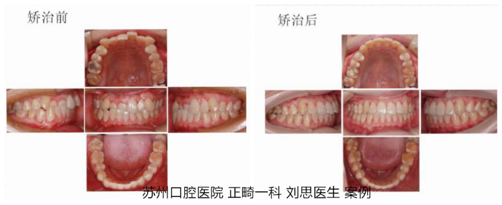 成年人矫正导致牙齿松动？成人矫正，到底难在哪？