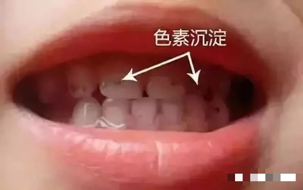 宝宝牙齿发黑被腐蚀，宝妈一个头两个大，看看以下办法能不能帮你