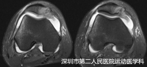 市二医院首创全关节镜微创技术--拯救你脱位的髌骨