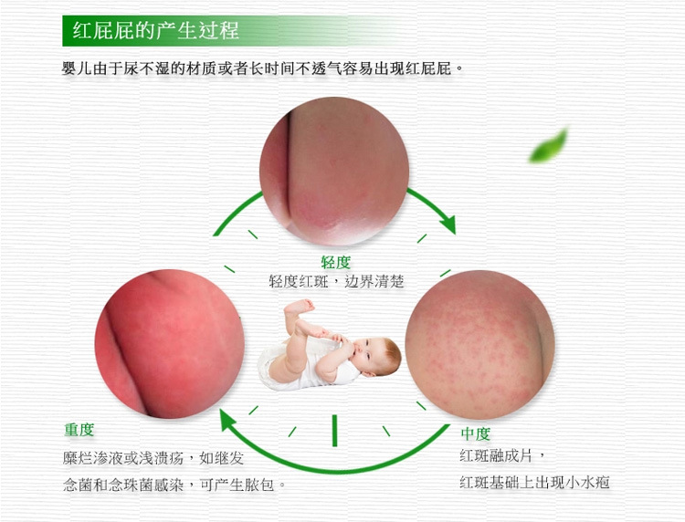 婴儿淹腚怎么办（宝宝红屁股）