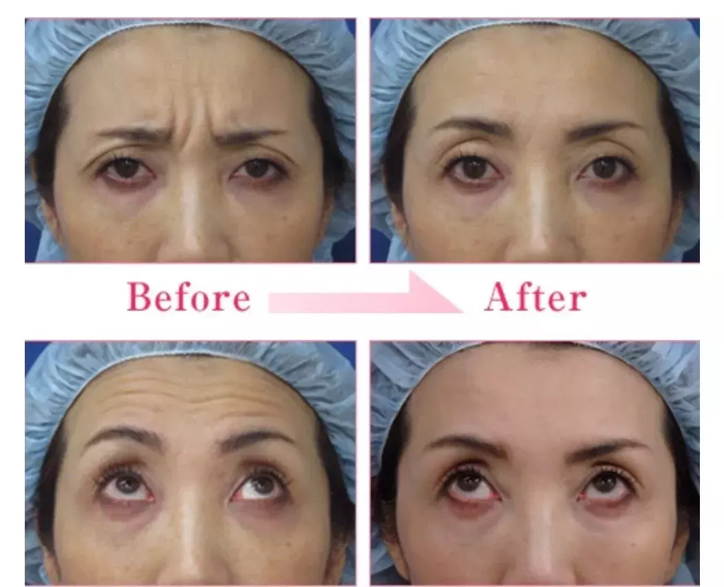 玻尿酸填充,肉毒瘦脸…真人体验告诉你这些医美项目值不值得做.