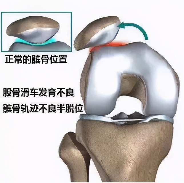 膝盖各个部位疼痛图解