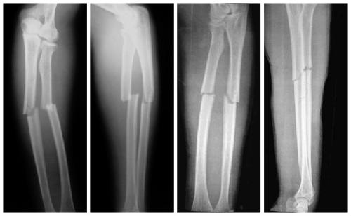 如果一根是横形骨折,一根是斜形骨折,先复位横行骨折.