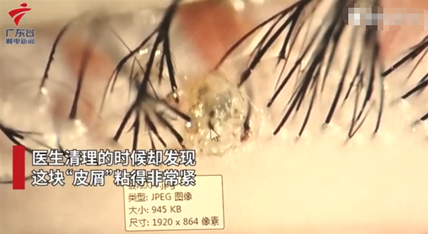 为什么现在还有人得阴虱？3种传播途径是“根源”，很多人中招