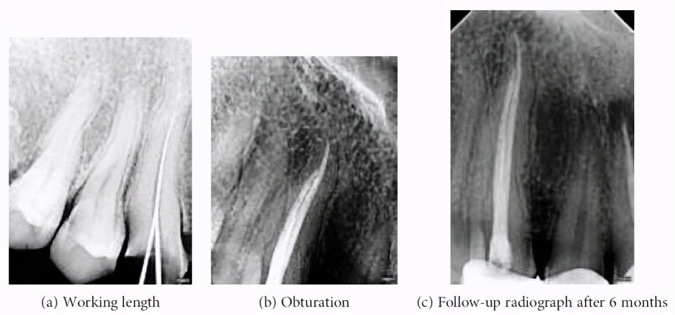 罕见病例！上颌犬牙Vertucci Ⅲ型结构的牙髓治疗