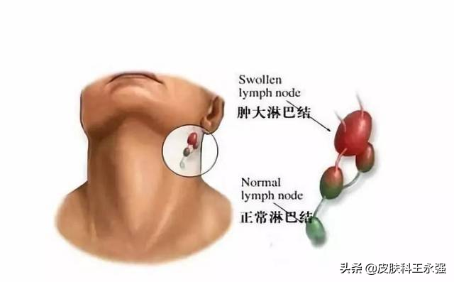 淋巴结出现这几个异常，暗示身体有病？对照看看，以免恶变