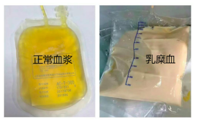 脂肪酶升高警示：甘油三酯偏高或致严重健康风险