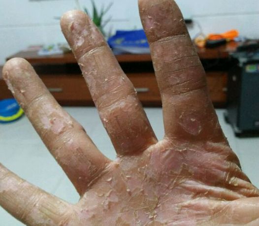 用于疮疡肿毒,乳痈,瘰疬,皮肤顽癣,鹅掌风,牙痛,风湿痹痛.