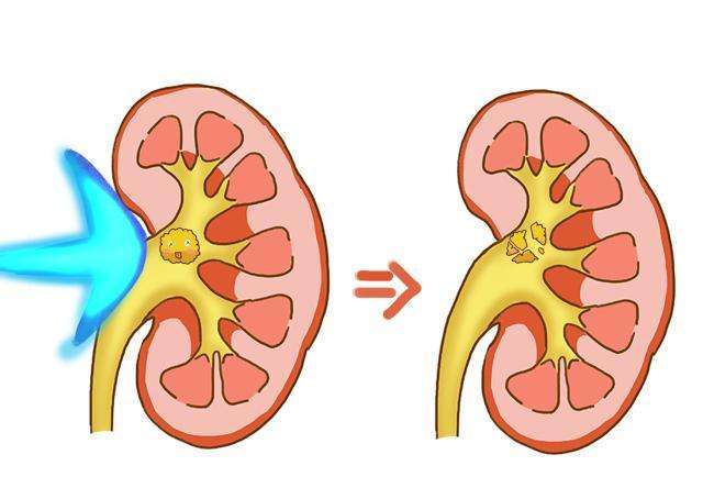 一位腎結石患者的忠告:不亂吃排石顆粒,補點鈣,疼痛別忍少跳動